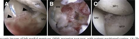 Figure From Augmentation Of The Pullout Repair Of A Medial Meniscus Posterior Root Tear By