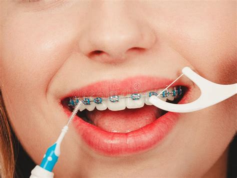 How to clean between your teeth with braces. Woman Smiling Cleaning Teeth With Braces Stock Image ...