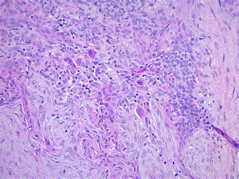 Pathology Outlines Chondroid Syringoma