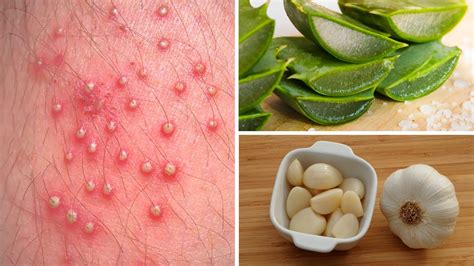 7 Powerful Home Remedies To Get Rid Of Folliculitis Youtube