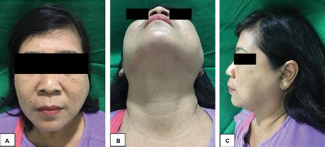 Patients Preoperative View Showing Swelling Of The Left Parotid