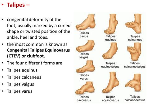 Notes On Clubfoot And Talipes Equiovarus Pcl Nursing 2nd Year