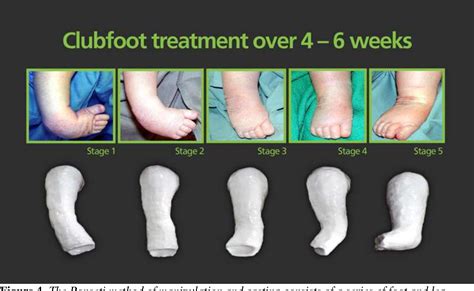 Pdf Congenital Talipes Equinovarus A Case Report Of Bilateral