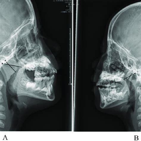 Lateral Nasopharynx X Ray Examination Of One Patient Before Treatment