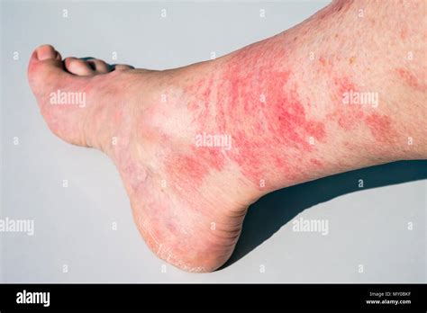 Vasculitis Of Legs Hi Res Stock Photography And Images Alamy