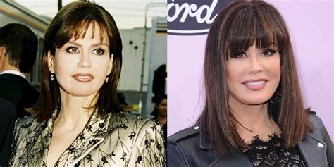 Did Marie Osmond Have Plastic Surgery Her Face Before And After
