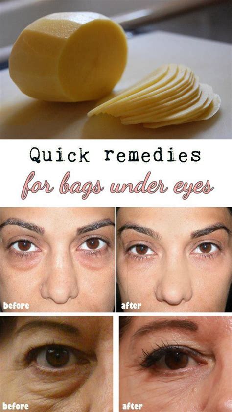 Quick Remedies For Bags Under Eyes Health Lala Homemade Beauty Diy Beauty Beauty Care