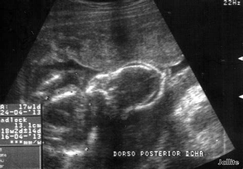 Óbito Fetal