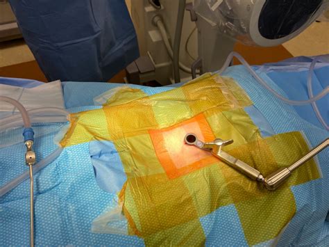 Minimally Invasive Surgery In Nj Comprehensive Spine Care