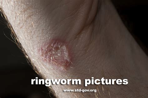 Ringworm Pictures Causes And Symptoms How Does It Look Like