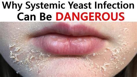 Signs Of Systemic Yeast Infection Why Systemic Yeast Infection Can Be