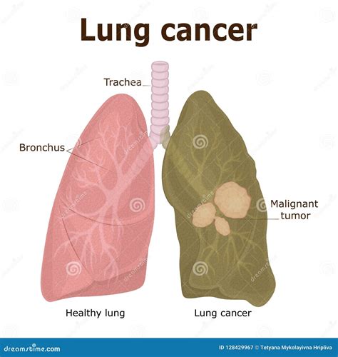 Illustration Of Lung Cancer Stock Vector Illustration Of Cell