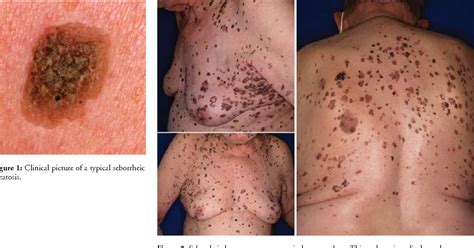 Macular Benign Skin Lesions Seborrheic Keratosis Kulturaupice