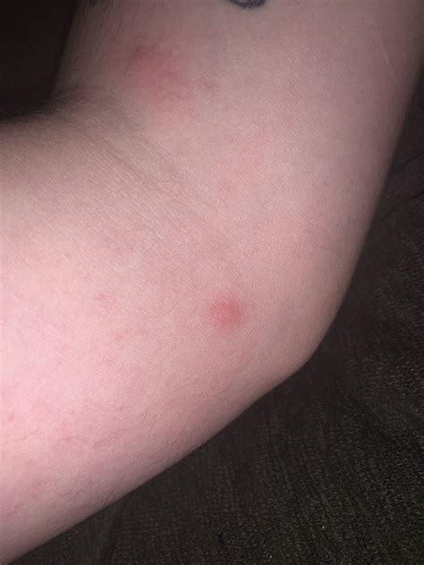 Are These Bed Bug Bites I Wake Up With Them Not Painful But Itchy I