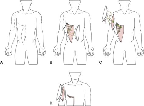 Schematic Representation Of Pedicled Rectus Abdominus Harvest