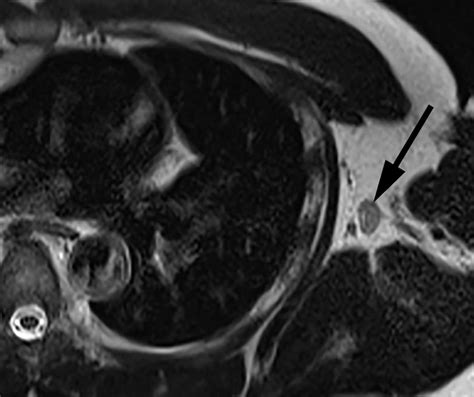 Diagnostic Imaging On Twitter Post Vaccine Axillary Lymphadenopathy