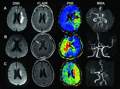 Reperfusion Therapy In Unclear Onset Stroke Based On Mri Evaluation