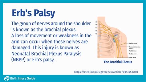 Erbs Palsy Causes Symptoms And Treatment Birth Injury Guide
