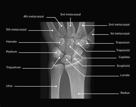 Wrist Anatomy X Ray Labeled