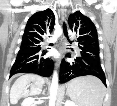 Image Coronal Reconstruction Ct Pulmonary Angiography Msd Manual