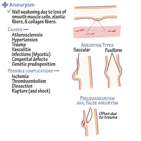Pathology Glossary Aortic Aneurysm And Dissection Draw It To Know It
