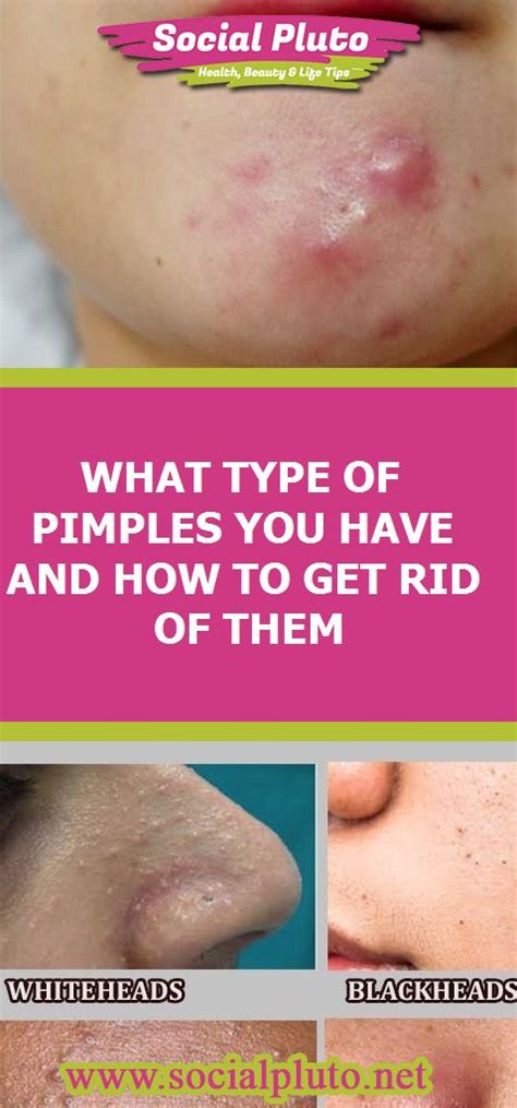 What Type Of Pimples You Have And How To Get Rid Of Them Pimples How
