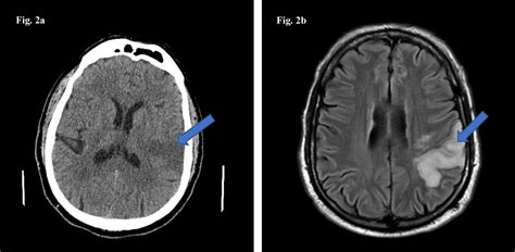 Acute Ischemic Stroke Ct Scan Ct Scan Machine Images