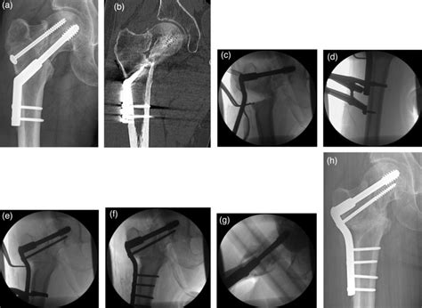 Managing Failed Fixation Valgus Osteotomy For Femoral Neck Nonunion