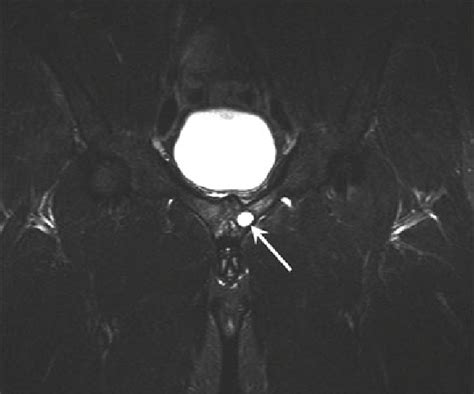 10 A 30 Year Old Triathlete Presented With Chronic Groin Pain Most