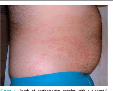 Adult Blaschkitis Lichen Striatus In A Patient Treated With