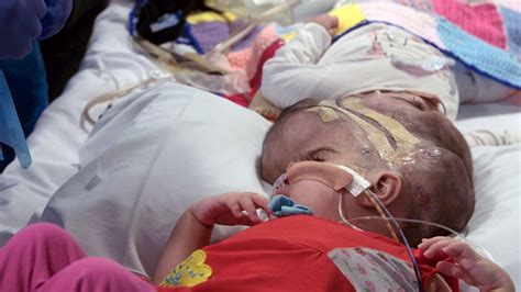 doctors separate 2 year old conjoined twin sisters and this is how they did it huffpost uk