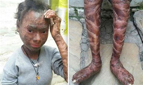 Teen Thrown Out Of School Because Skin Condition