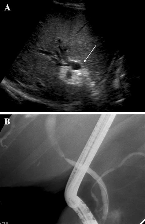 Anastomotic Biliary Stricture A Ultrasound Shows Moderate Intrahepatic