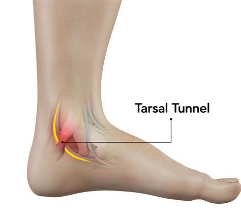 Tarsal Tunnel Syndrome Treatment Management Visa Medicure