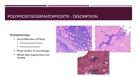 Ppt Dermatomyositis And Polymyositis Powerpoint Presentation Free Download Id