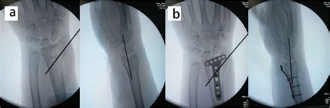 The Intraoperative C Arm Images Showing The Temporal Fixation Of The