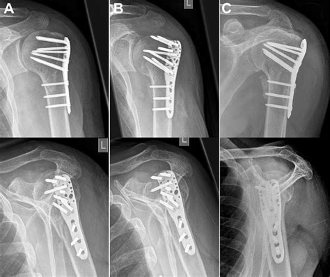 A Initial Radiographs In Anteroposterior And Lateral Views After Open