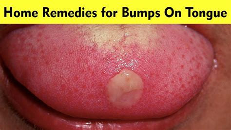 How To Get Rid Of Bumps On Tongue That Hurt 12 Home Remedies For