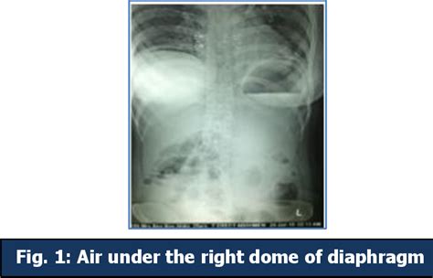 Figure 1 From Peritonitis Due To Transverse Colon Perforation A Rare