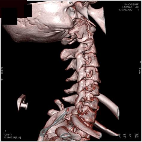 C 1 Cervical Fracture Musculoskeletal Case Studies Ctisus Ct Scanning