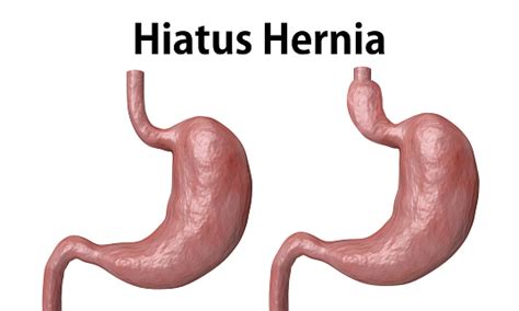 The Hiatal Hernia Is The Advancement Of Part Of The Stomach Towards The