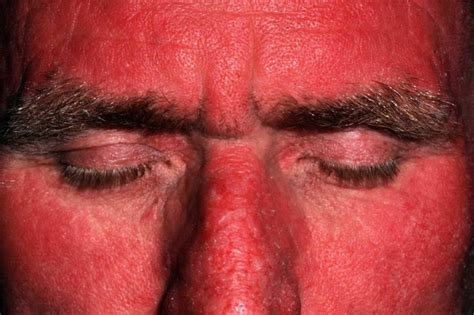 Polymorphic Light Eruption Causes Rash Treatment
