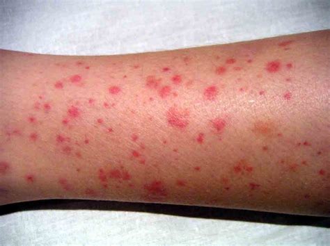 Tiny red spots in your skin (petechiae). When to Worry about A Rash in Adults? - Healthella - Page 13