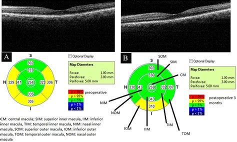 Spectral Domain Optic Coherence Tomography Analysis Mm Mode Download Scientific Diagram