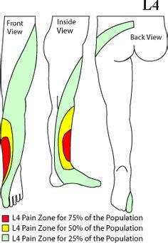 Disc herniation above this level is more common in. Sciatic Nerve Pain in Leg | FEMORAL NERVE : Roots L2, L3 & L4 (front and side of the thigh pain ...