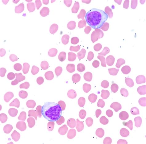Reactive Lymphocytes In Peripheral Blood Infectious Monon