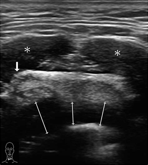 Point Of Care Ultrasonography In Transverse View Of The Neck Depicting