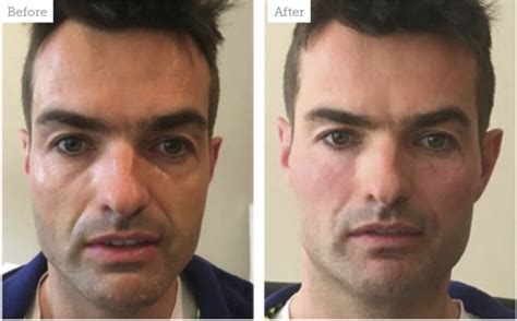 Male Facial Revolumisation With Dermal Fillers Eastbourne Eye Clinic