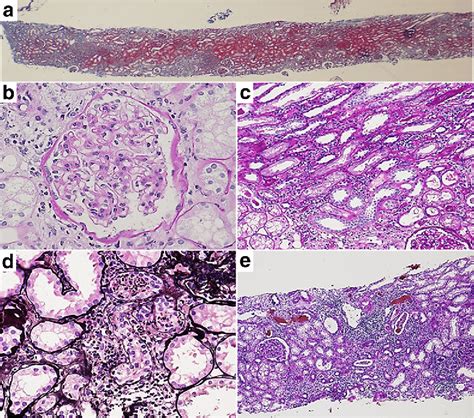 Kidney Biopsy Slide Specimen Showing A Subcapsular And Medullary Ray