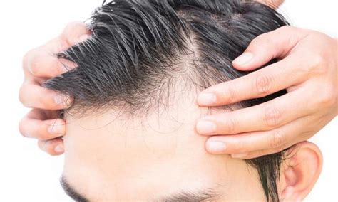 Everything You Need To Know About Treating Male Hair Loss